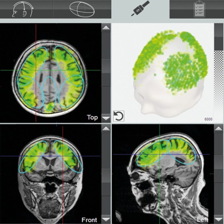 TPS - Transkranielle Pulsstimulation in Hannover