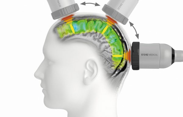 TPS-Technologie – Gezielte Hirnstimulation mit NEUROLITH® Bildschirmdarstellung der TPS-Navigation zur gezielten Anwendung akustischer Impulse in ausgewählten Gehirnregionen.